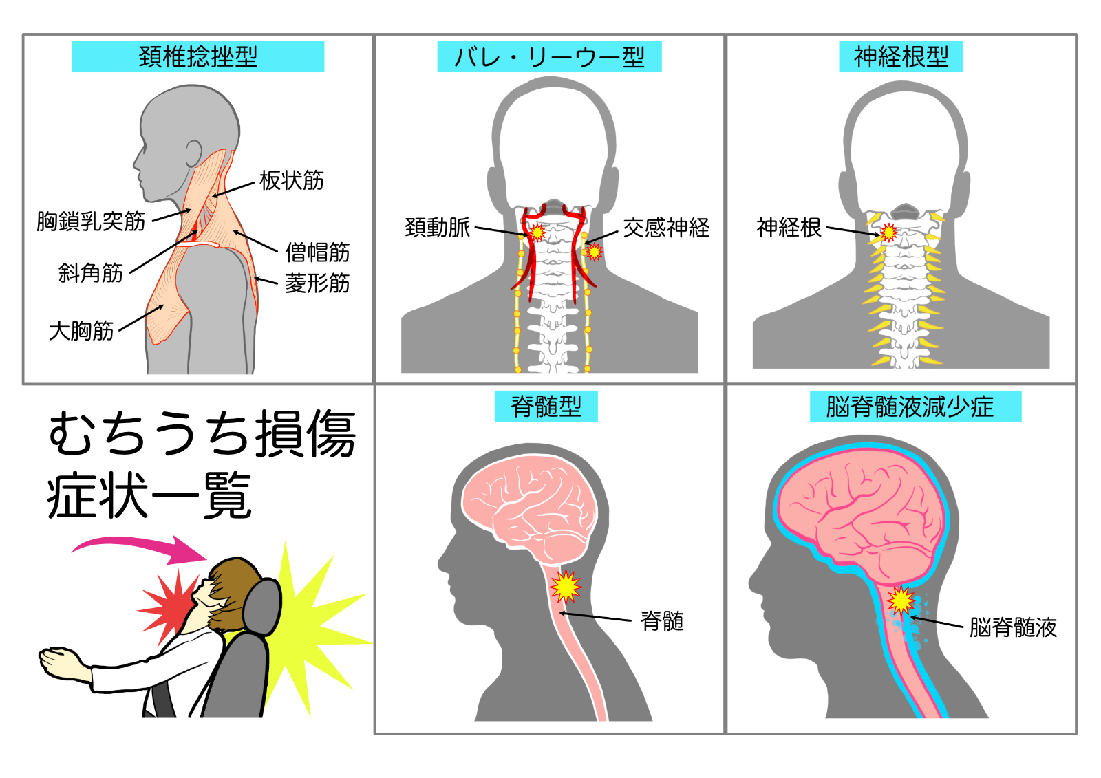 むちうち損傷の症状一覧（頚椎捻挫型・バレ–リーウー型・神経根型・脊髄型・脳脊髄液減少症）